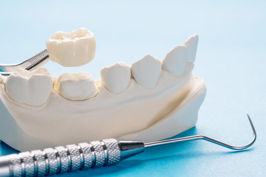 Dental crown prosthetic