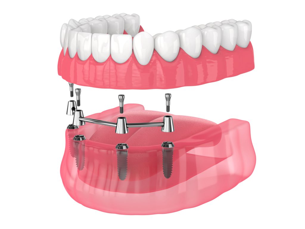 Full-arch implant: