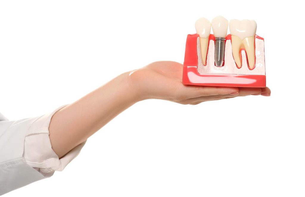 Single implant: