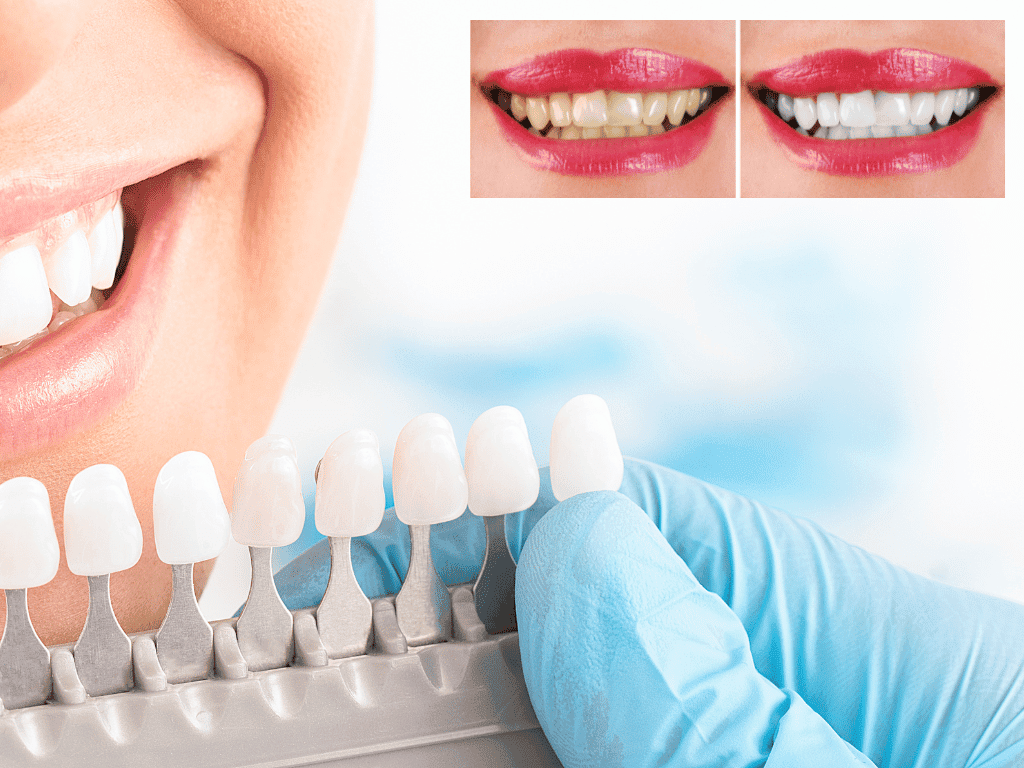 Teeth Whitening Cost